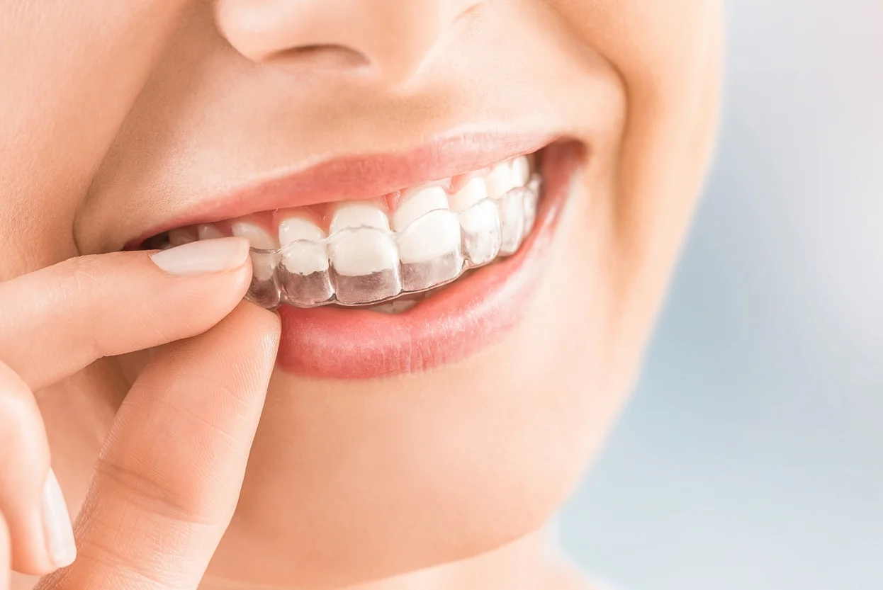 Braces