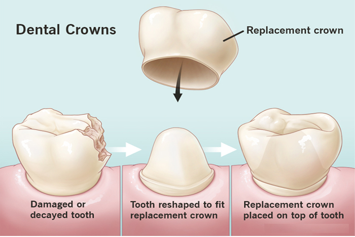 Dental Crown