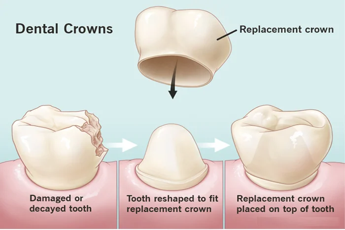 Dental Crown