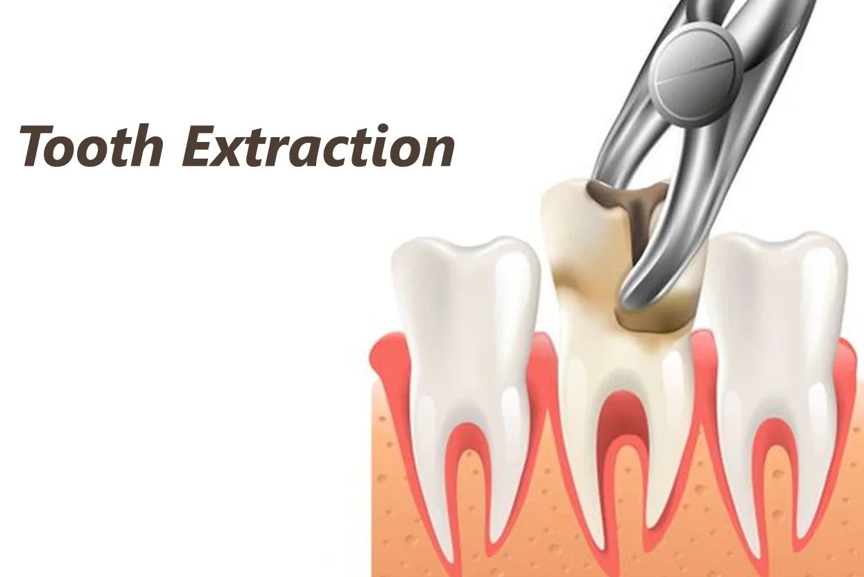 Extraction